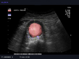 Ultrazvok žil trebuha - anevrizma abdominalne aorte, prečno